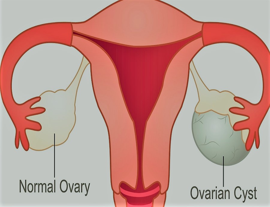 ovarian cyst and its tpes