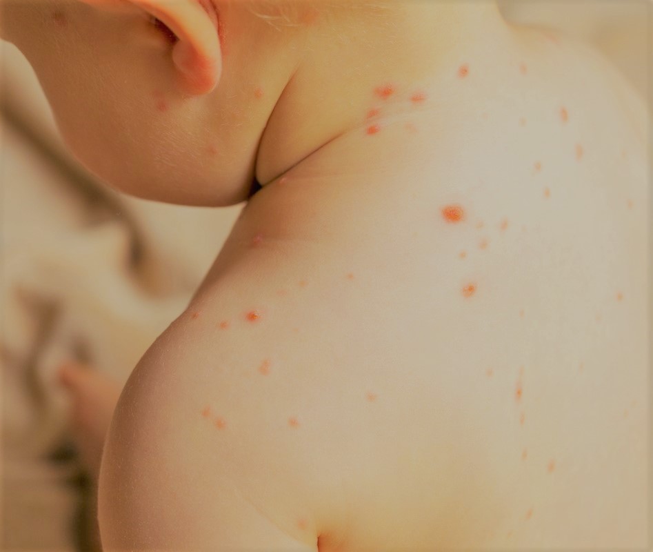 chickenpox