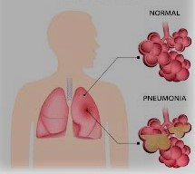 pneumonia its symptoms and casuses