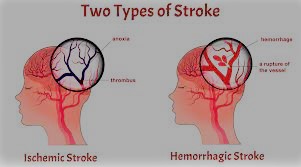 stroke and its types, Strokes Prevention Recovery